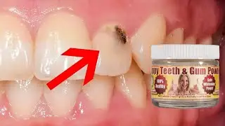 🦷 Dr. Arenander's Organic Teeth Powder for Cavities Protection | Natural Oral Care 🌱✨