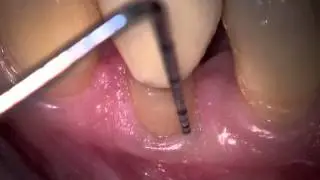 Clinical Crown Lengthening
