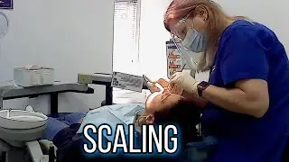 Removal dental tartar / scaling by dental hygienist
