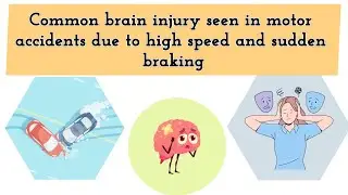 Common brain injury seen in motor accidents due to high speed and sudden braking ‼️