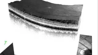 Multimodal Fungus Imaging in Foveal Hypoplasia