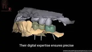 Perfect Post and Core Design for a Dental Laboratory