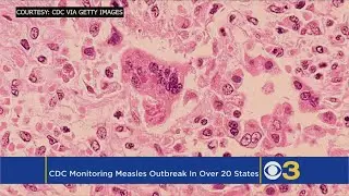CDC Monitoring Measles Outbreak In Over 20 States