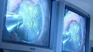 Confocal Endomicroscopy