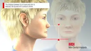 B&B Dental | Mini Dental implant line - stabilization of a denture