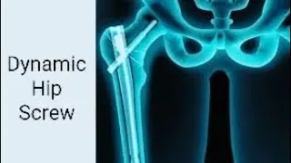 Dynamic Hip Screw: Surgical Technique and Rehabilitation Tips