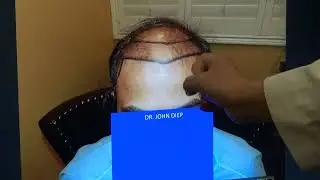 The Art of Hair Transplant Restoration Surgery Results | 1-Year Follow-up at MHTA Clinic