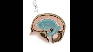 Updated Video Available: Endoscopic Third Ventriculostomy Animation