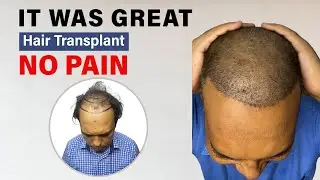 Painless Hair Transplant in Delhi | 100% Safe & Natural Results
