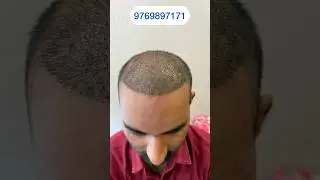 15 Days after hair transplant by DHI method