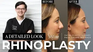 Rhinoplasty: A Detailed Look at Dr. Leong's Approach