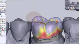 Fixed Prosthodontics - Full Contour Crown Design & Coping