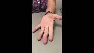 Finger Tip Amputation Reattachment