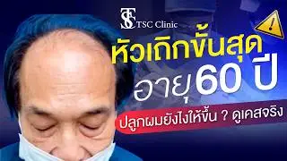 หัวเถิกขั้นสุด ผมบางระดับสูง อายุ 60+ ปลูกผมได้ไหม?