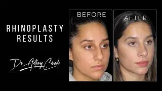 Stunning Nose Job: Before & After Rhinoplasty Reveal | Dr. Anthony Corrado