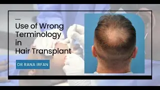 The Shocking Mistake You're Making with Hair Transplant Terminology|| What is the Donor Area?
