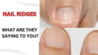 The hidden reasons for the nail ridges #HolisticHealing#NutrientDeficiency
