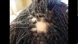 From Hair to Bare -  How I lost all my hair to Alopecia 07b