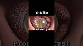 Treatment of Prostate Cyst www.dradityaurologist.com