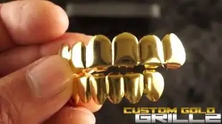 14k Gold 6 Tooth Grills by Custom Gold Grillz