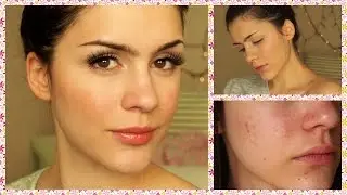 ⭐️ Last Acne Update! How I Cured My Acne! Doxycycline Therapy Update! ⭐️