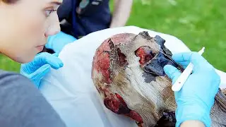 The melted fabric had fused with the man's skin |Chicago Fire