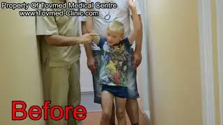 Before and After Cerebral Palsy Surgery | Case Example 2 | Tovmed Medical Center