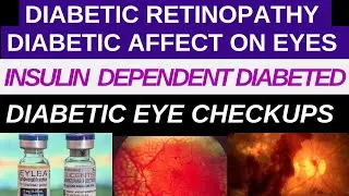 Diabetic Retinopathy And Macular Odema Treatment #drfaisalanwar #eyedoctor