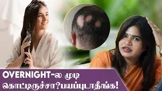 Alopecia areata-க்கு Latest Treatment இதான்! | Dr Radha Subramaniyan