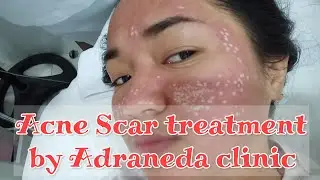 6th Session of FRACTIONAL RF with TCA cross/ACNE SCARS REMOVAL by Adraneda