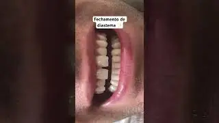 Resina composta fechando um diastema 💛 #dentistas #dentista #odontologiaestetica #odontologia