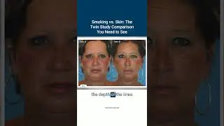 Smoking vs. Skin - The Twin Study Comparison You Need to See