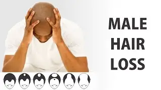 Male Hair Loss | Male Baldness | Male Hair Fall Treatment | Male Pattern Hair Loss Natural Remedies