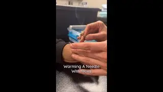 What Is Moxibustion?​
