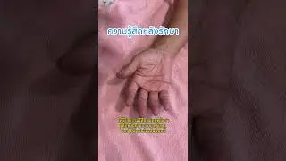 Trigger Finger Recovery: Visible Improvement After Second Treatment!✨