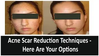 Acne Scar Treatments: Types Of Scars & Their Treatments | The Esthetic Clinics, India