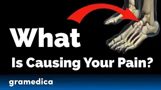 What Is Posterior Tibial Tendon Disease? (And Why It Keeps Getting Worse)