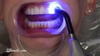 Cosmetic Dentistry Before and After Prepless Veneers. Teeth Stained.
