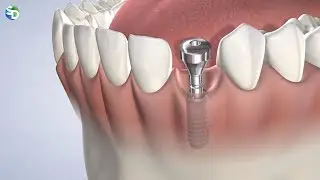 Tooth Replacement in San Diego, CA