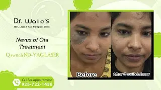 Nevus of Ota Treatment I Qswitch Ndyag laser I Dr Walia's Skin and Hair Transplant Clinic