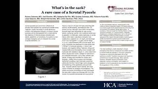 What's in the Sack? A rare case of a Scrotal Pyocele