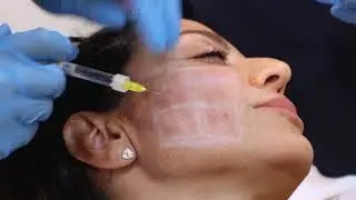 Almudena se pone en manos de Bloome: neuromoduladores y skinbooster