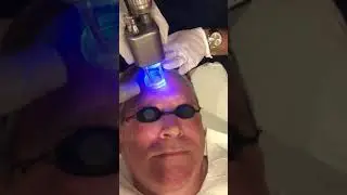 CO2 Skin Rejuvenation Treatment