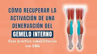 C&oacute;mo recuperar la activaci&oacute;n de una denervaci&oacute;n del gemelo interno