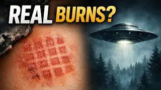 Falcon Lake UFO Incident (1967): The Man Who Suffered Mysterious Burns