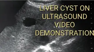 Liver Cyst on ultrasound images. A practical video demonstration for understanding