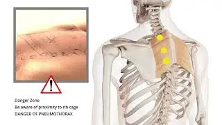 Trigger Point Release | Shoulder Pain | Rhomboids