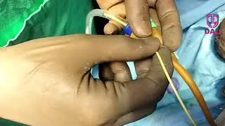 How to make the connection of ureteric catheter with Foley catheter water tight in  Hindi