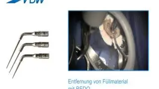 VDW Dental &middot; How To: VDW.ULTRA - Entfernung von F&uuml;llmaterial