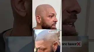 What are the disadvantages of                Scalp Micropigmentation !